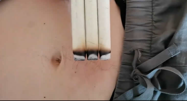 灸法种类：排灸